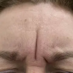 Gdzie kupić botox Allergan? Sprawdzone miejsca i ważne informacje
