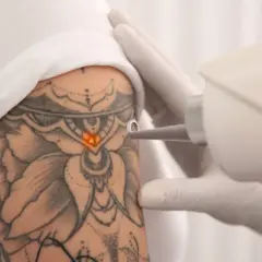 Jak usunąć tatuaż bez bólu? Skuteczne metody i ich ryzyko