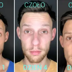 Kiedy widać efekty po botoksie? Zaskakujące wyniki już po 3 dniach