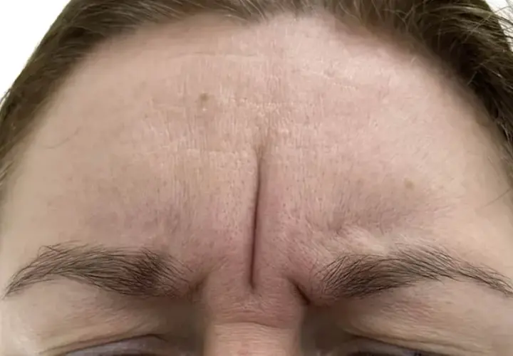 Gdzie kupić botox Allergan? Sprawdzone miejsca i ważne informacje