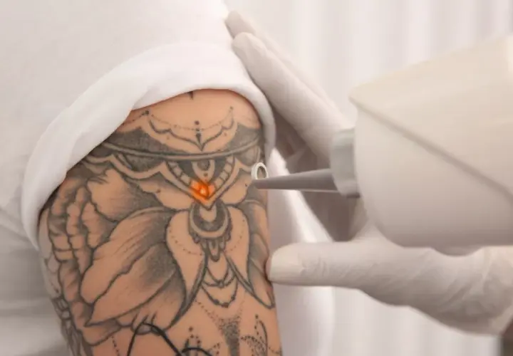 Jak usunąć tatuaż bez bólu? Skuteczne metody i ich ryzyko