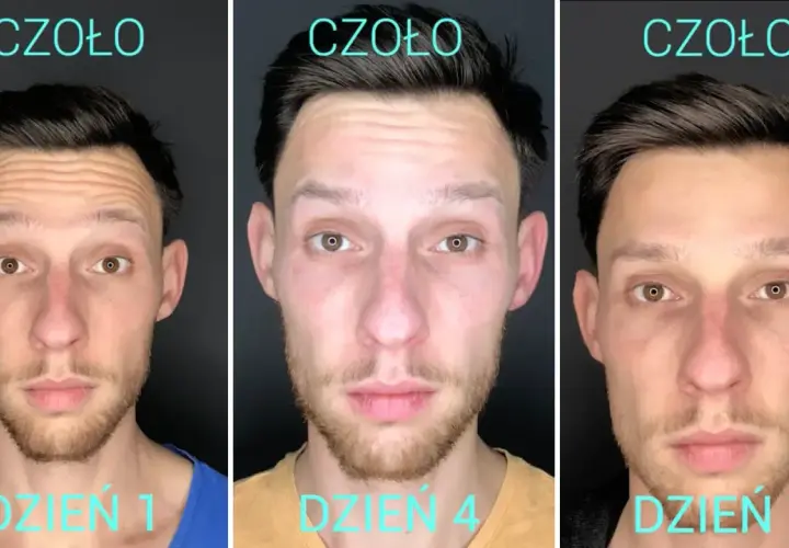 Kiedy widać efekty po botoksie? Zaskakujące wyniki już po 3 dniach