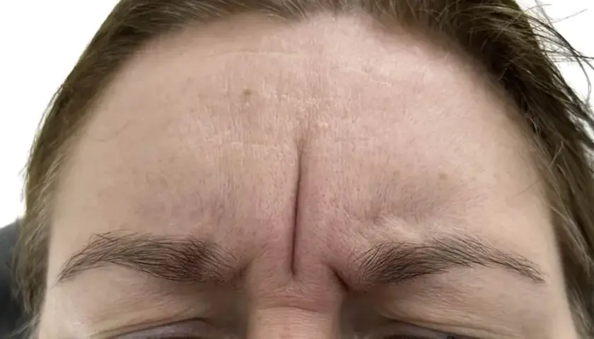 Gdzie kupić botox Allergan? Sprawdzone miejsca i ważne informacje