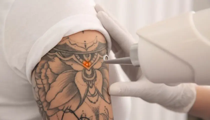 Jak usunąć tatuaż bez bólu? Skuteczne metody i ich ryzyko