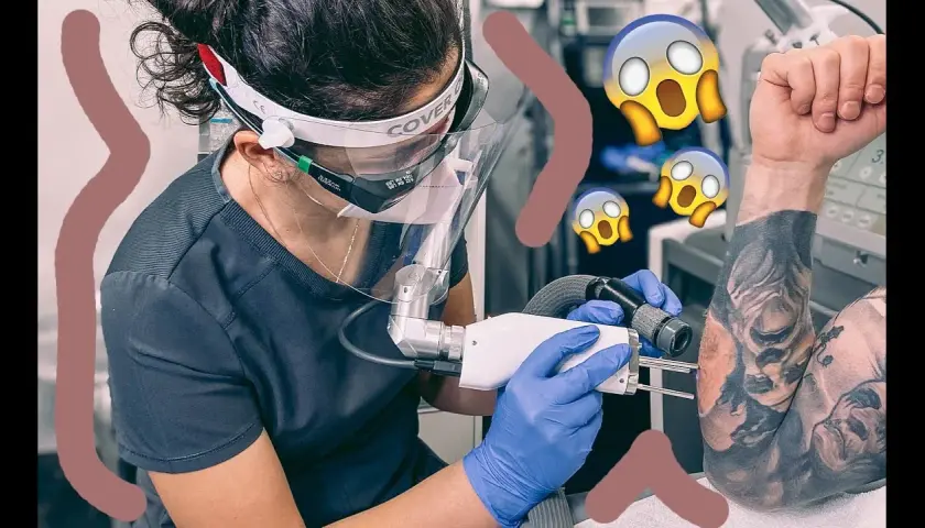 Jak wygląda usunięty tatuaż? Efekty i proces laserowego usuwania