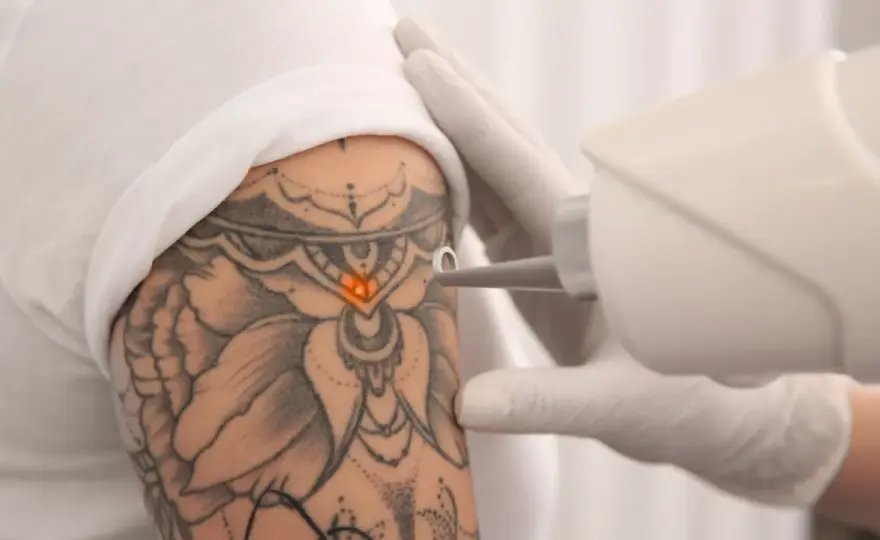 Jak usunąć tatuaż bez bólu? Skuteczne metody i ich ryzyko